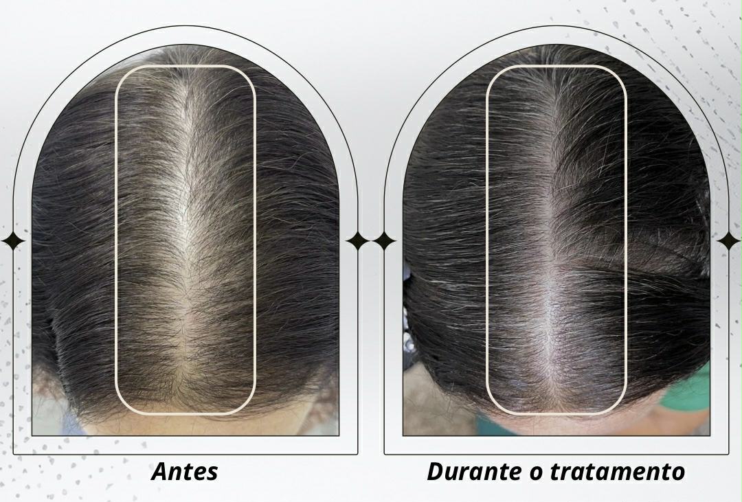 Antes e durante o tratamento capilar — evolução após 6 meses