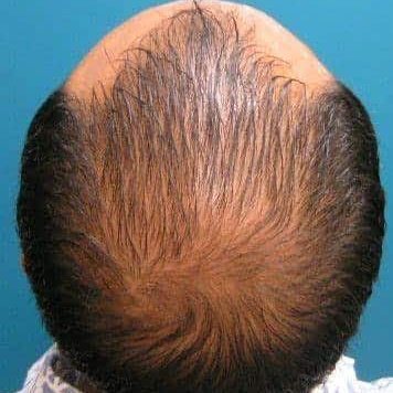 Couro cabeludo com alopecia androgenética