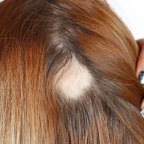 Falha circular no couro cabeludo — alopecia areata