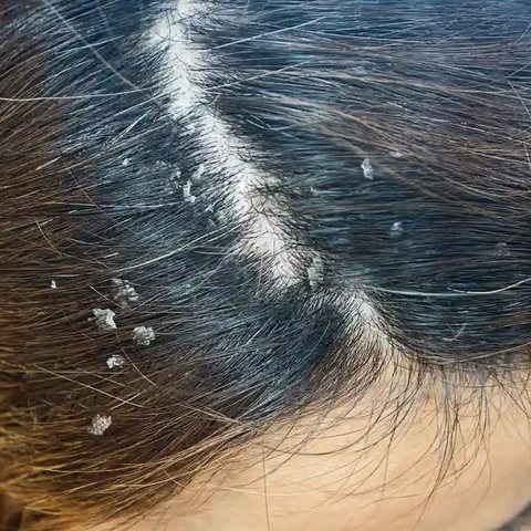 Couro cabeludo com descamação — dermatite seborreica